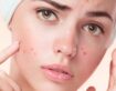 آکنههای سمج: چطور بفهمم مشکل پوستی دارم یا هورمونی؟