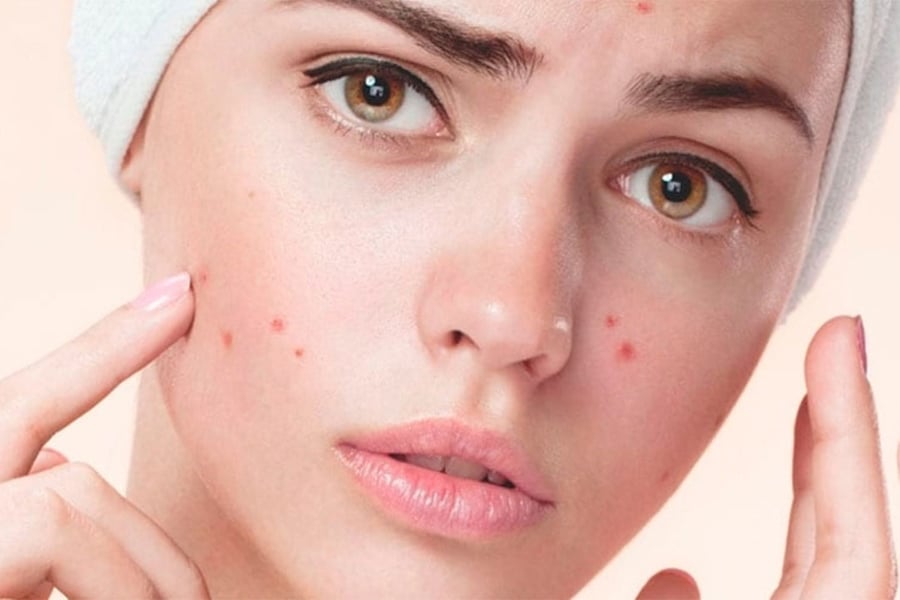 آکنه‌های سمج: چطور بفهمم مشکل پوستی دارم یا هورمونی؟